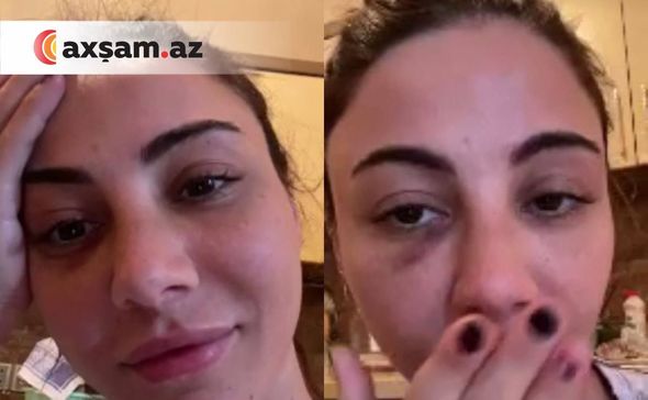 Məşhur müğənnimiz qəza törətdi, sifəti tanınmaz hala düşdü – FOTO