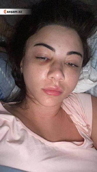 Məşhur müğənnimiz qəza törətdi, sifəti tanınmaz hala düşdü – FOTO