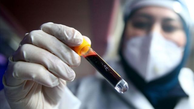 Azərbaycanda koronavirusa yoluxanların bu günə olan statistikası