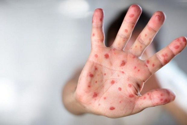 Azərbaycanda meymunçiçəyi virusunun diaqnostika və müalicəsi üzrə klinik protokol hazırlandı