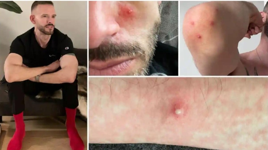 Meymunçiçəyinə yoluxan xəstə danışdı: "Bədənimdə yaralar və..."
