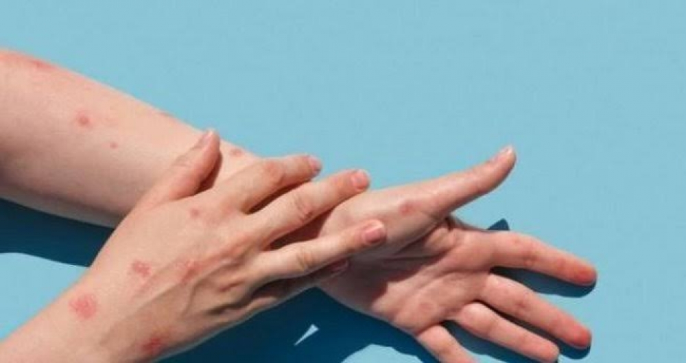 Türkiyənin Səhiyyə nazirindən XƏBƏRDARLIQ: Ölkədə meymunçiçəyi kəskin artır