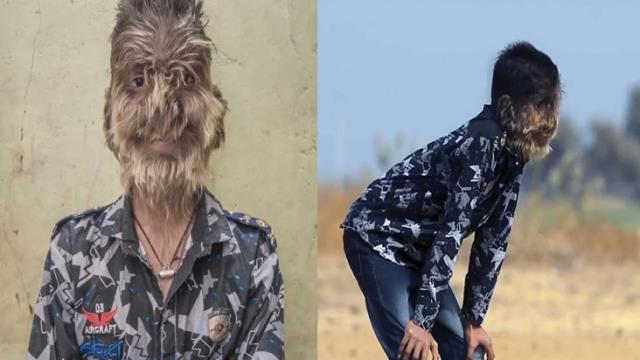 "Canavar adam" sindromu ilə doğulan uşağı görənlər şoka düşdü - FOTOLAR