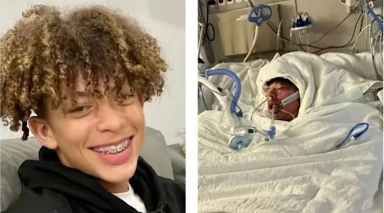 “TikTok” trendi onun həyatını qaraltdı: Bədəninin 75 faizi yandı