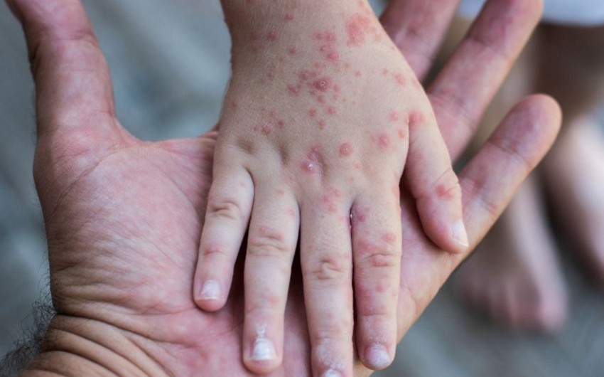 Zaqatalada qızılcaya yoluxanların son durumu açıqlandı