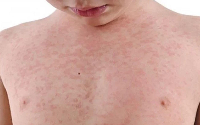 “Qızılca peyvənd olunmayan uşaqlar arasında yayılıb” - Rəsmi