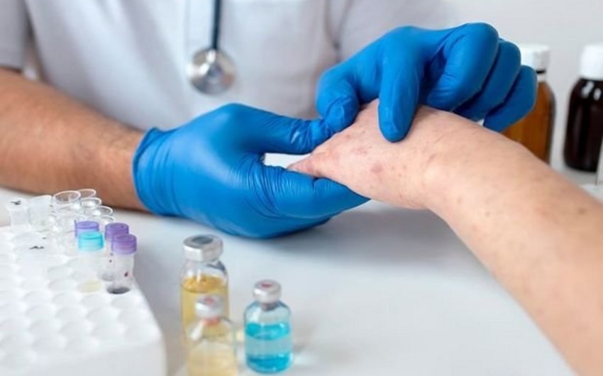 Azərbaycanda bir universitetin 8 tələbəsi qızılcaya yoluxdu