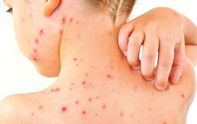 Qızılcaya yoluxma ilə bağlı xəbərdarlıq: Təhlükəli vəziyyət gözlənilir?