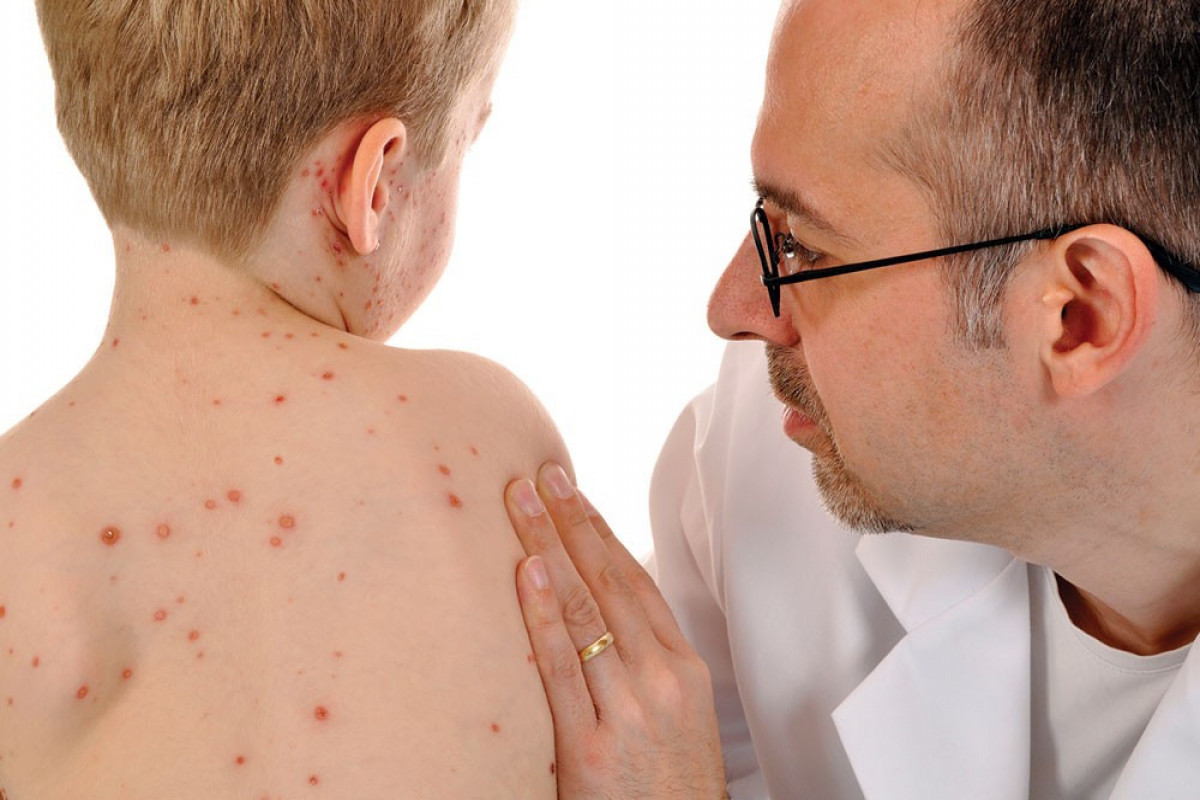 Valideynləri qorxuya salan "qızılca" nədir? - Yoluxarkən nə etmək lazımdır? - VİDEO