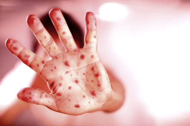 Azərbaycanda qızılcaya yoluxanların rəsmi SAYI