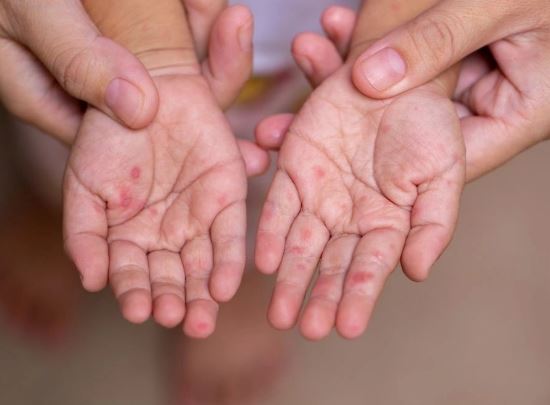 Astarada azyaşlı qızılcadan öldü