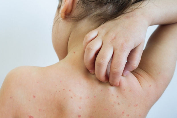 Bu ölkədə yeni epidemiya sürətlə yayılır