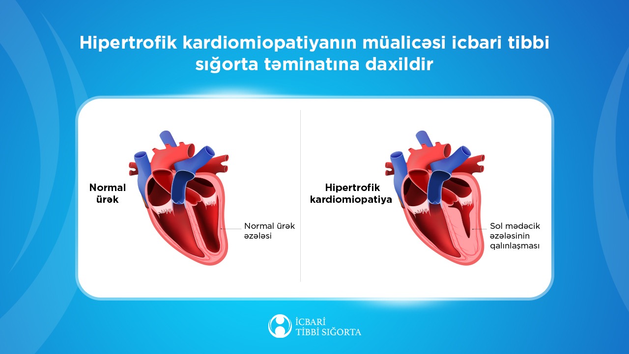 Hipertrofik kardiomiopatiyanın müalicəsi icbari tibbi sığorta təminatına daxildir