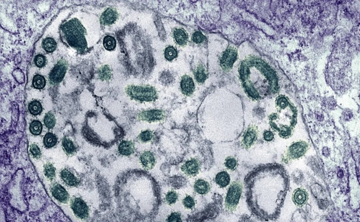 Efiopiyada təhlükəli virusun yayıldığı təsdiqlənib