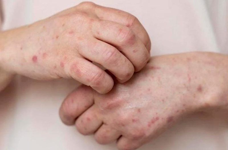 Qızılca Avropada rekord səviyyəyə çatdı: ÜST-dən xəbərdarlıq