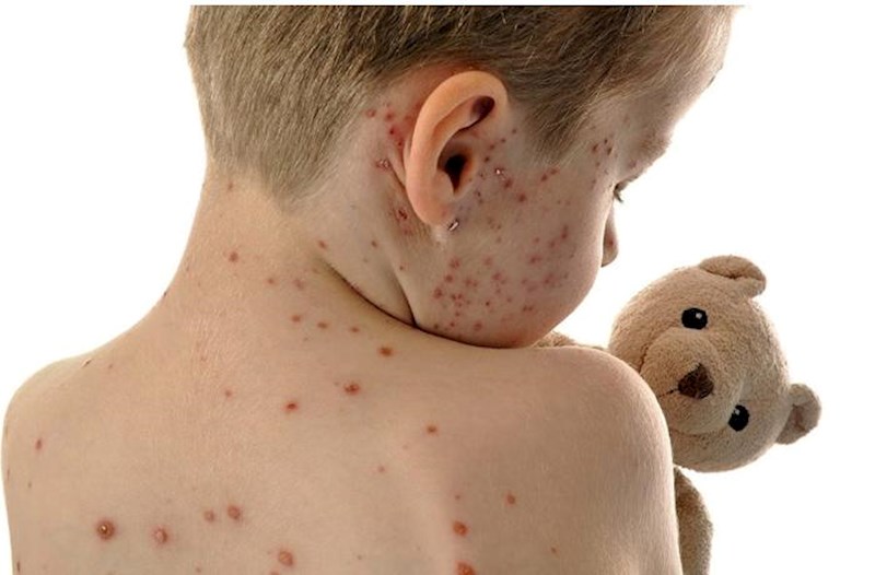 Uşaqlar arasında suçiçəyi xəstəliyi yayılıb - VİDEO