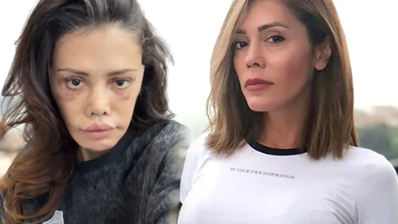 Keçmiş "Survivor" iştirakçısı üz nəqli etdirdi