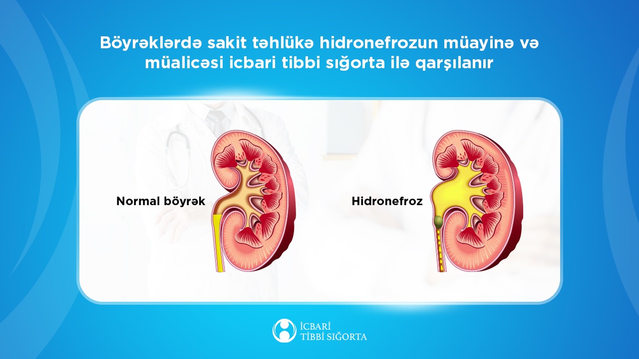 Hidronefrozun müayinə və müalicəsi icbari tibbi sığorta ilə qarşılanır