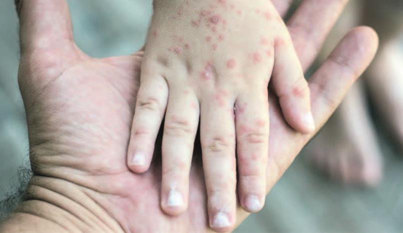 Bakıda uşaq evində azyaşlı qızılcadan öldü