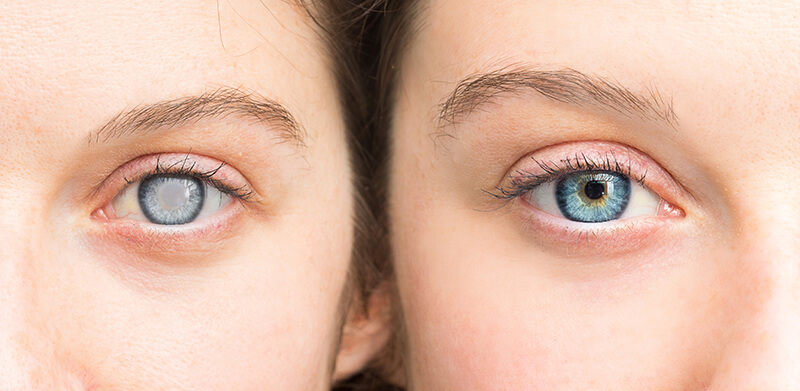 Katarakta nədir? - Əlamətləri və müalicəsi haqda bilmədikləriniz