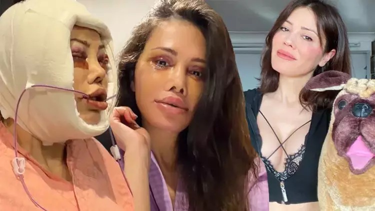 Üz nəqli etdirən fenomen xərçəng oldu