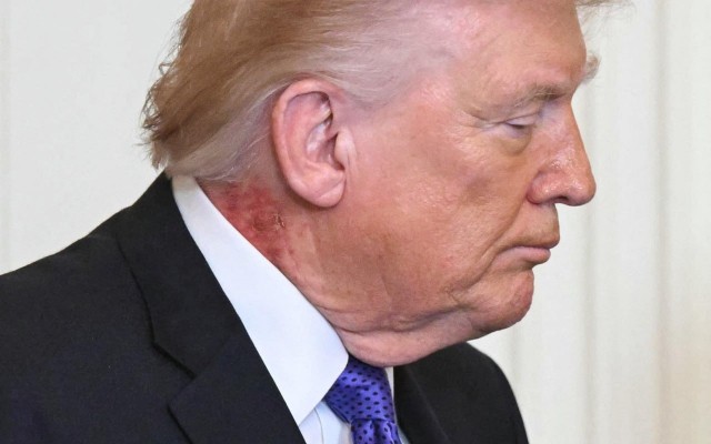 Boynundakı səpkilər müzakirə yaratdı - Foto