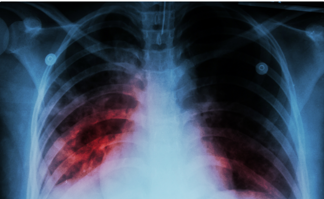 Ötən il 198 uşaq və yeniyetmə vərəmə yoluxub