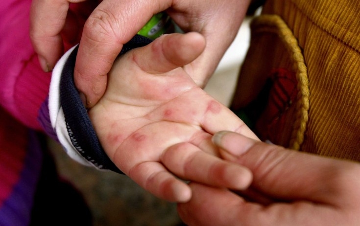 Ayaq və əllərdə göbələk varsa, bunu edin