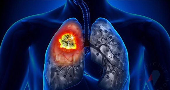 Ağciyər xərçənginə qarşı peyvənd hazırlandı - İnsanlar üzərində yoxlanılacaq