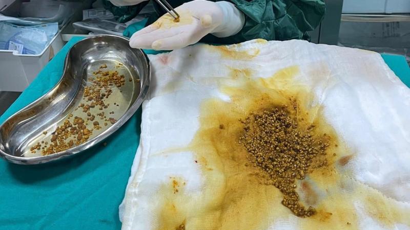 Həkimə qarın ağrısı ilə getdi - rekord sayda öd daşı aşkarlandı