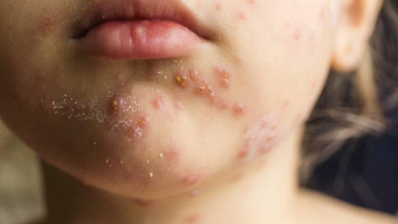Banqladeşdə qızılca epidemiyası dərinləşir: Ölən uşaqların sayı 712-yə çatdı