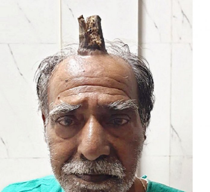 74 yaşlı kişinin başında “buynuz" çıxdı - FOTO