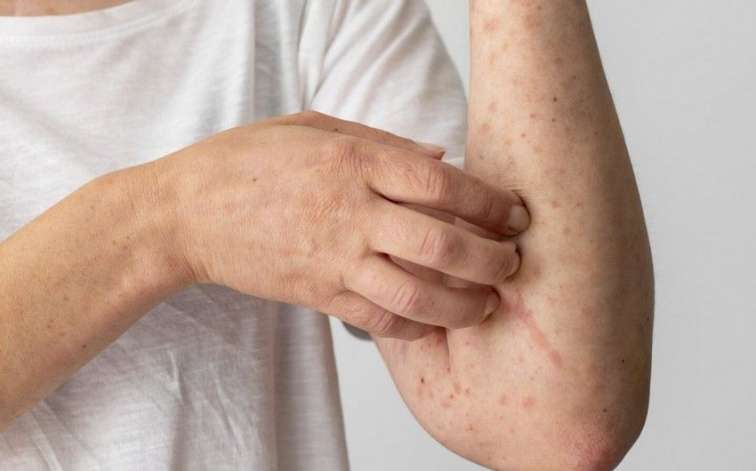 Qızılca və suçiçəyinə yoluxanların sayı açıqlandı - RƏSMİ