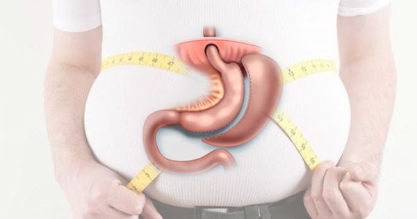 Çəki gedir, bəs sağlamlıq? – Mədəkiçiltmə əməliyyatının təhlükəli tərəfləri